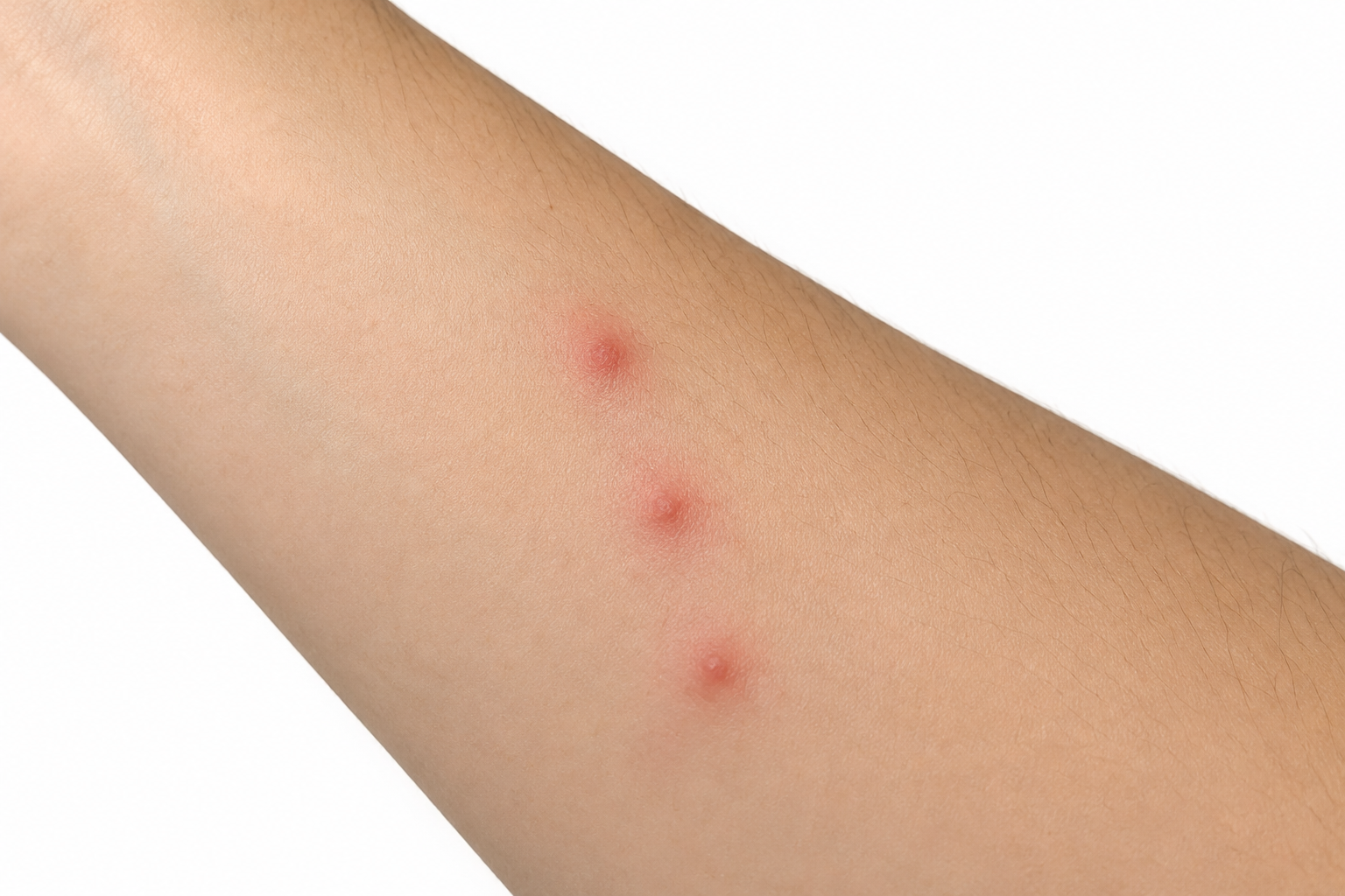 bed bug bites pictures on forearm showing straight line pattern