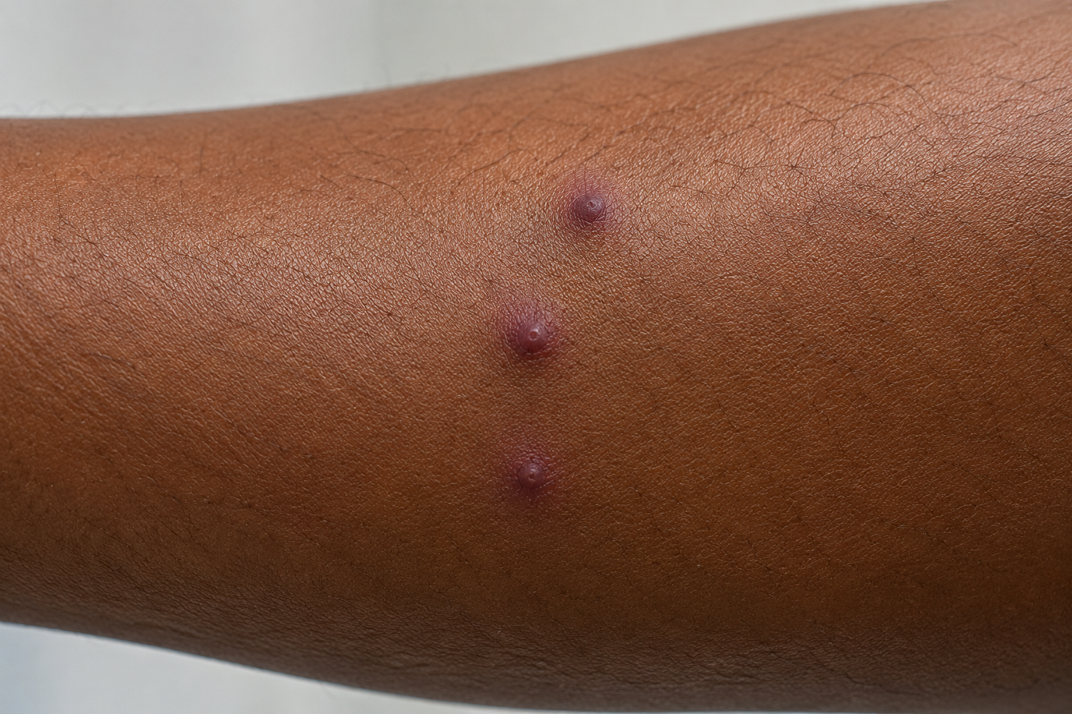 bed bug bites on dark skin appearing as purple pink raised bumps